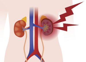 Inflammation d'un rein par une insuffisance rénale